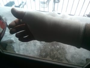 The cast over my broken finger