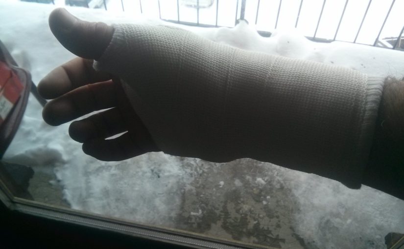 My casted broken finger - ski injuries