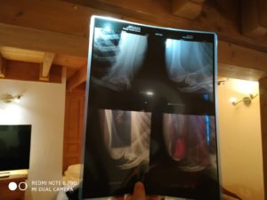 Guri friend dislocated shoulder - ski injuries