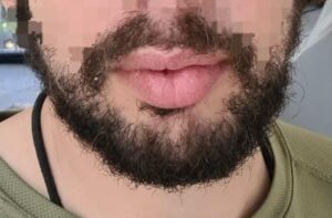 With a beard before the mustache