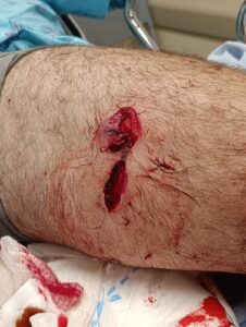 The wound in the leg: the entrance and exit of the shrapnel. There is probably another shrapnel in his leg. - Injury from the company